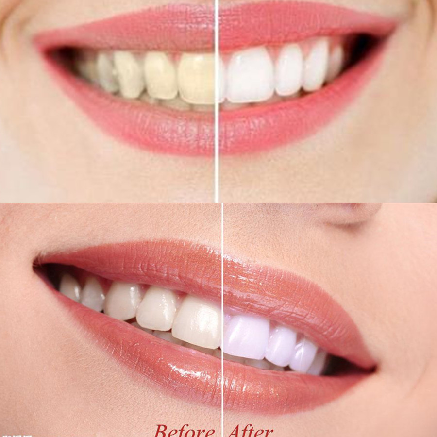 Bambus Holzkohle Zähne Zahn De – Teeth Whitening Price Bewertung und Preis