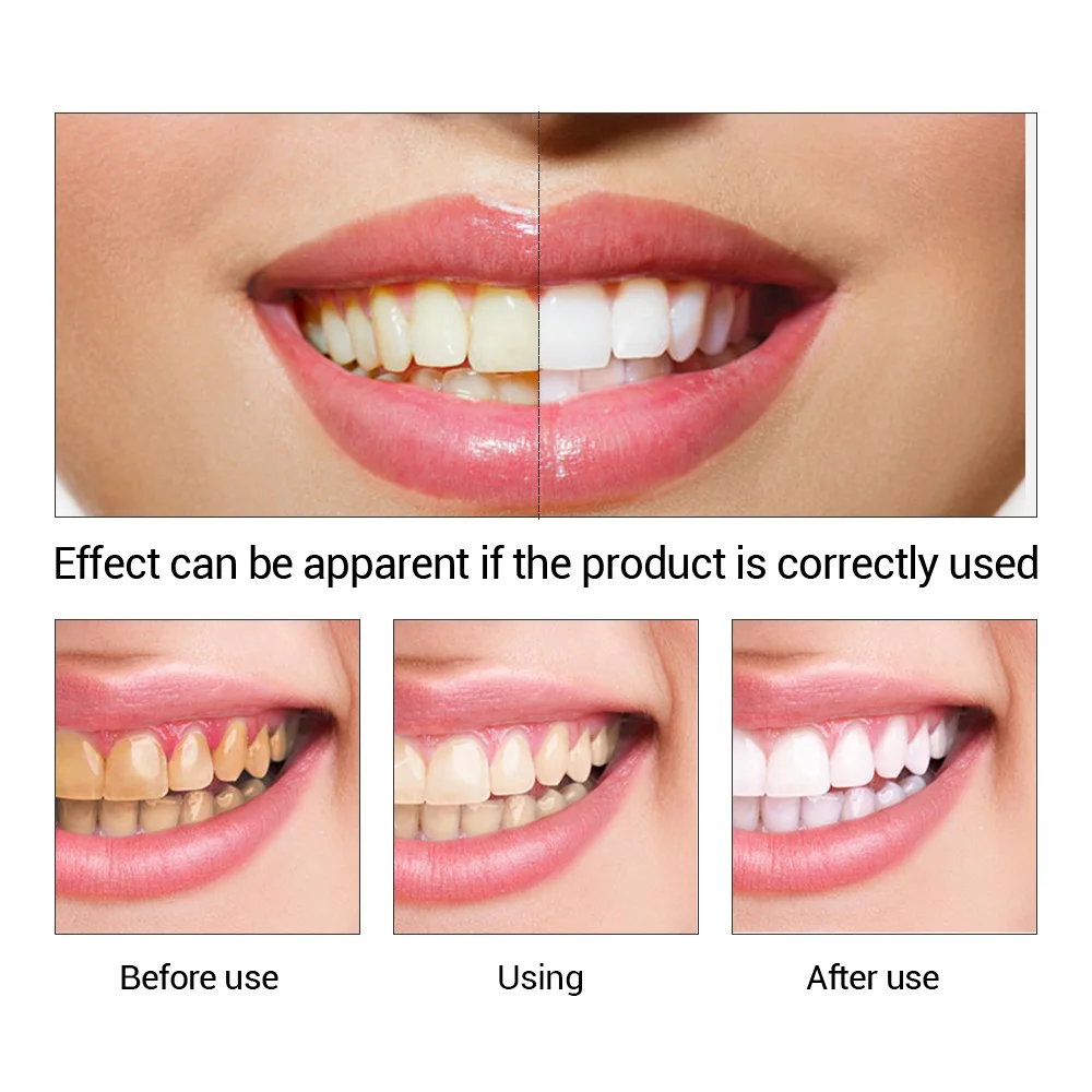 FTEENPLY Zahnaufhellung Essenz – Teeth Whitening Price Bewertung und Preis